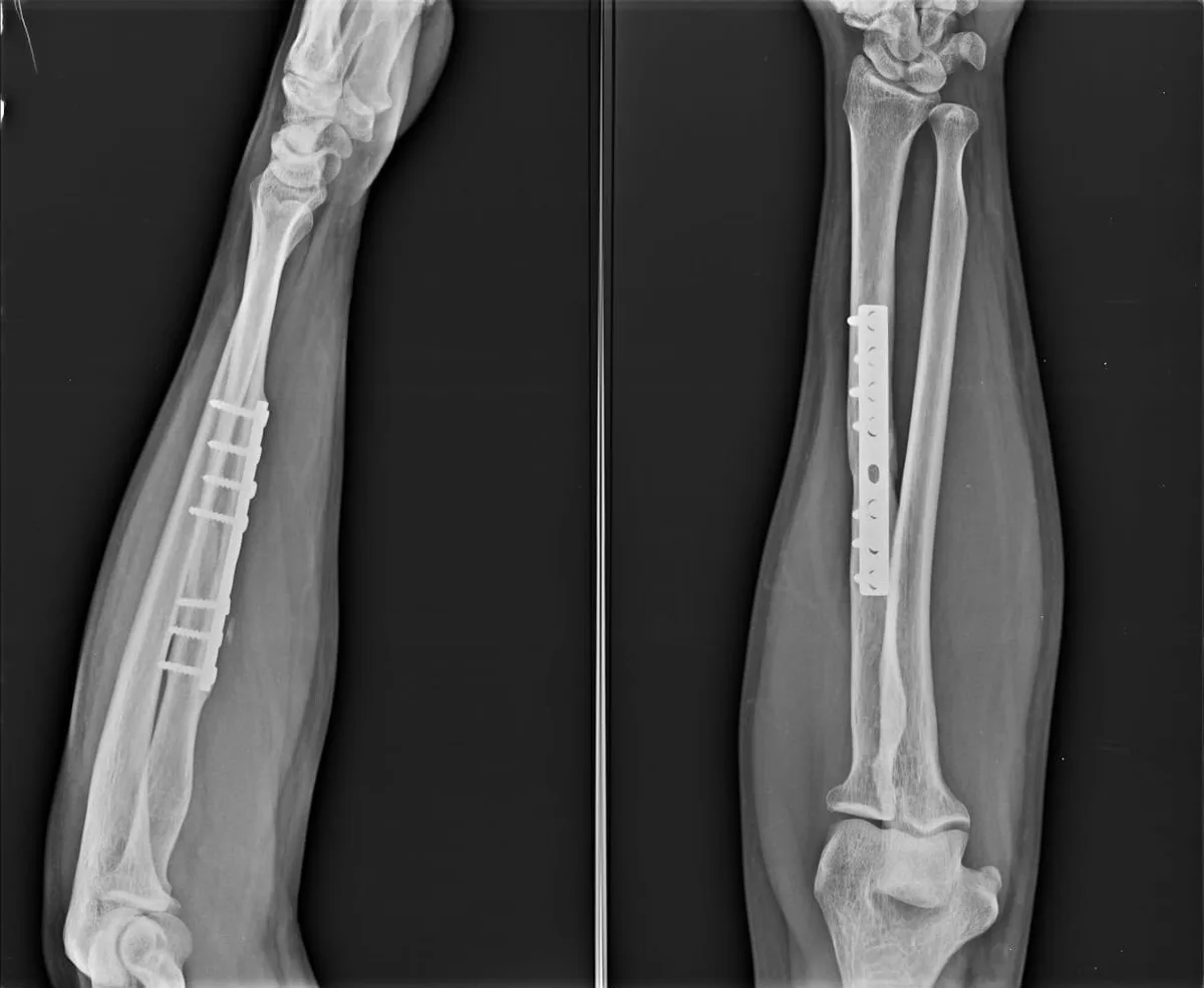 Radiografia de antebraço com placa e parafusos