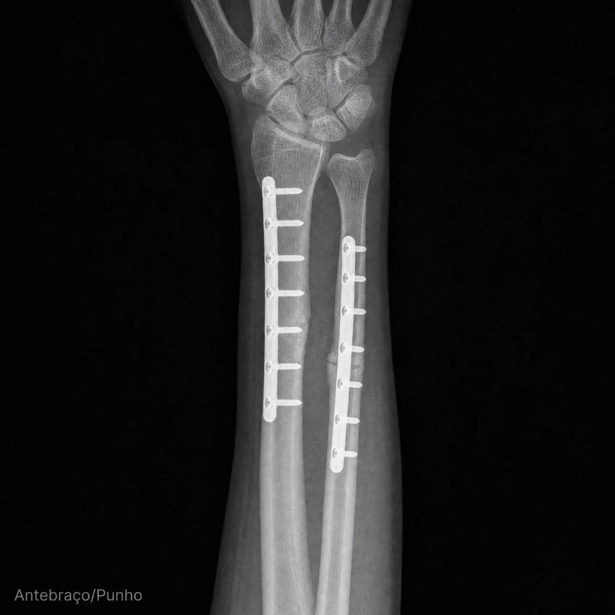 Radiografia de antebraço e punho com placas e parafusos