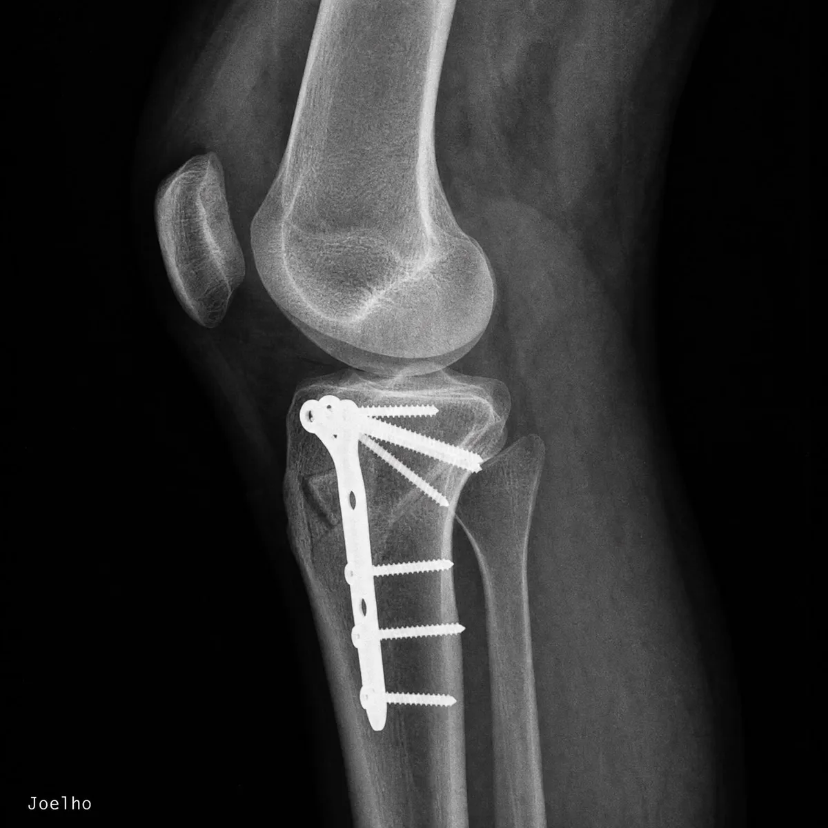 Radiografia de joelho com placa e parafusos
