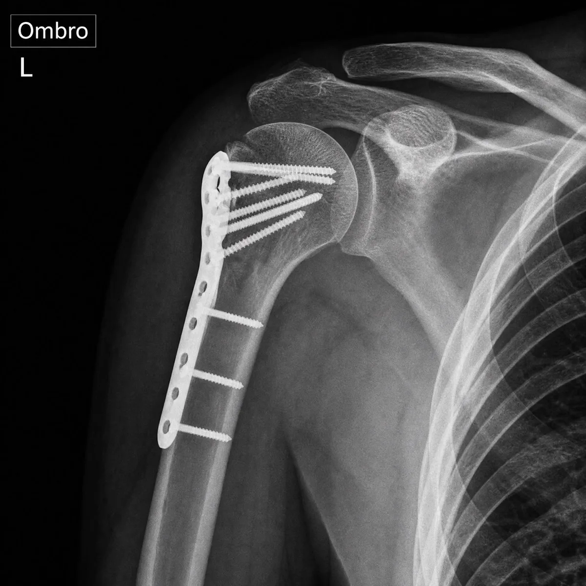 Radiografia de ombro com placa e parafusos