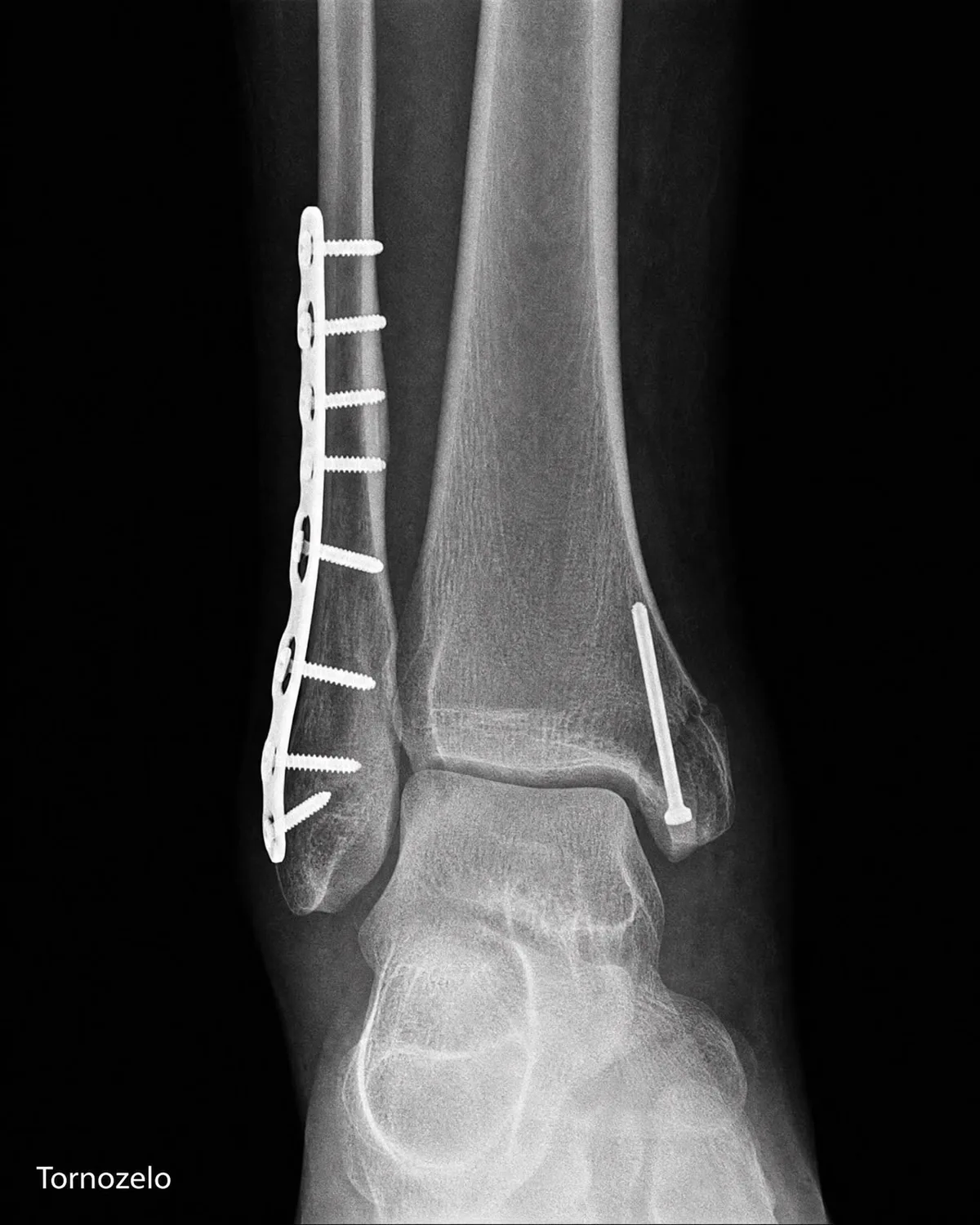 Radiografia de tornozelo com placa e parafusos